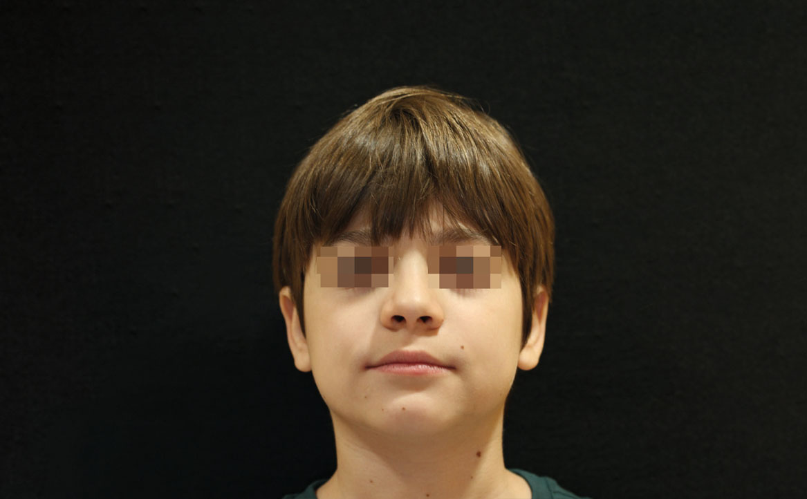 Fig. 11G Correzione della pseudo-classe III a fine trattamento.