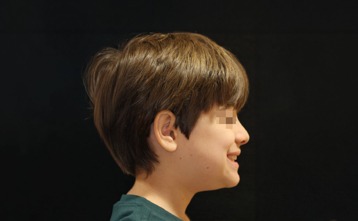 Fig. 11H Correzione della pseudo-classe III a fine trattamento.