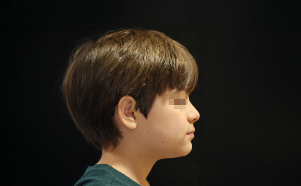 Fig. 11I Correzione della pseudo-classe III a fine trattamento.