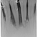 Fig. 1A Situazione iniziale foto e radiografia endorale.