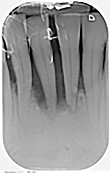 Fig. 1A Situazione iniziale foto e radiografia endorale.