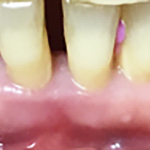 Fig. 1B Situazione iniziale foto e radiografia endorale.