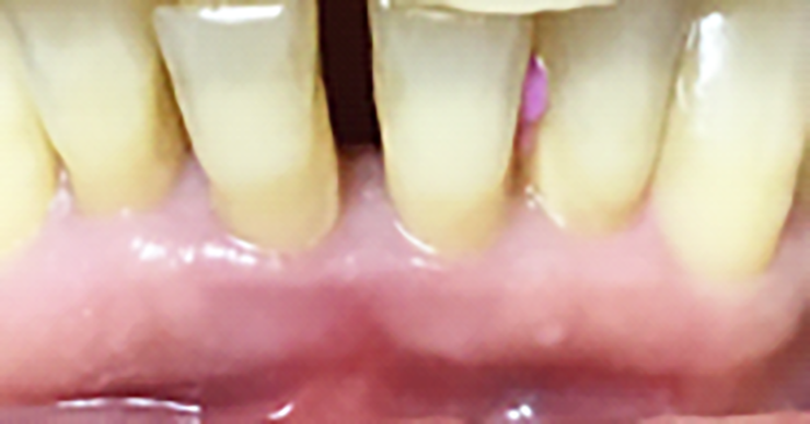 Fig. 1B Situazione iniziale foto e radiografia endorale.