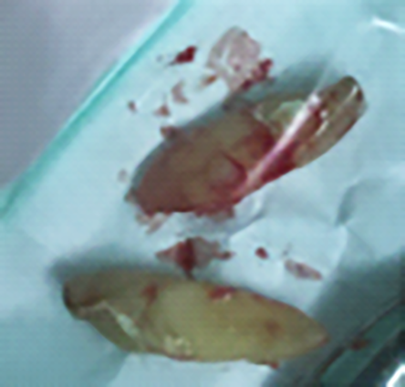 Fig. 3 Dettaglio dei denti estratti.