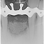 Fig. 4 Radiografia endorale di controllo post intervento di estrazione con rigenerativa.