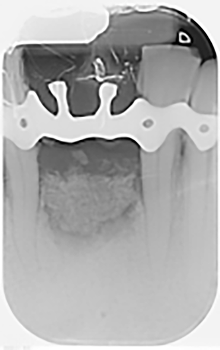Fig. 4 Radiografia endorale di controllo post intervento di estrazione con rigenerativa.