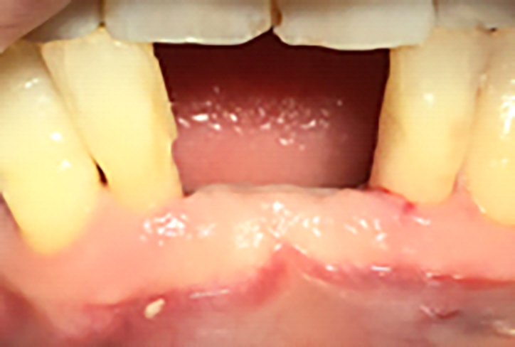 Fig. 5 Guarigione dopo estrazione con rigenerativa.