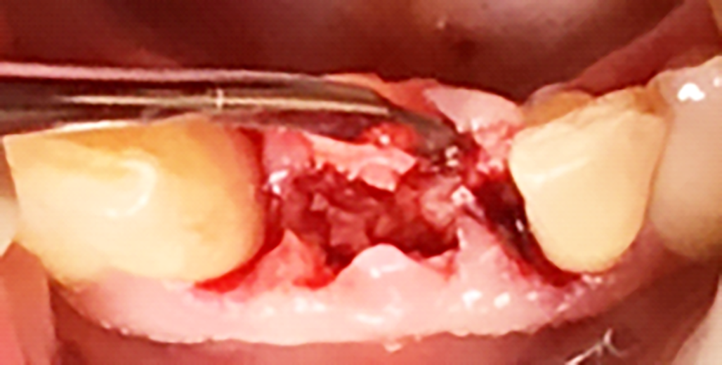 Fig. 7 Incisione, disegno e scollamento del lembo per l’inserimento implantare.