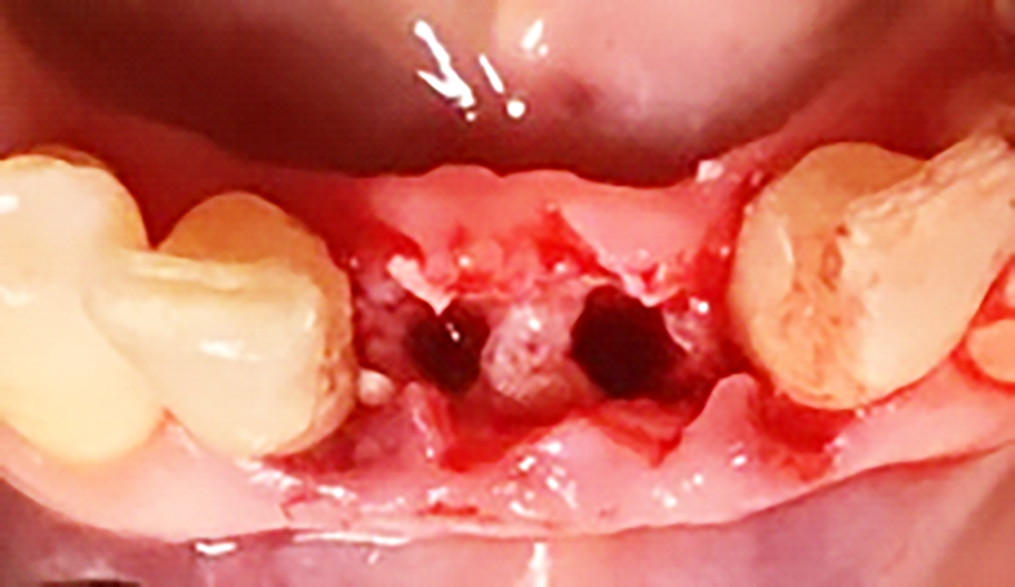 Fig. 8 Preparazione dei fori implantari con mascherina chirurgica.