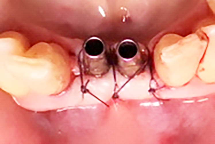 Fig. 10 Inserimento dei pilastri definitivi e sutura.
