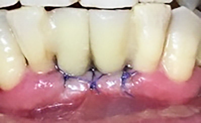 Fig. 11 Posizionamento dei provvisori ribasati.