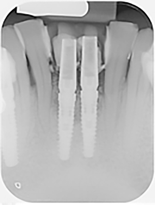 Fig. 12 Radiografia endorale di controllo post chirurgia.