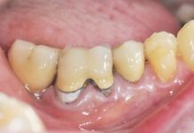 Impianto post estrattivo con rigenerazione ossea e utilizzo di Tissucol Fig. 1 Immagine iniziale 4 sestante.
