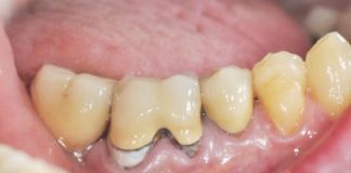 Impianto post estrattivo con rigenerazione ossea e utilizzo di Tissucol Fig. 1 Immagine iniziale 4 sestante.