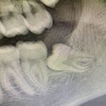Fig. 1 OPT preoperatoria.