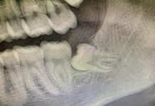 Avulsione di elementi inclusi inferiori con metodica tradizionale Fig. 1 OPT preoperatoria.