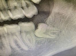 Fig. 1 OPT preoperatoria.