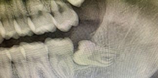 Avulsione di elementi inclusi inferiori con metodica tradizionale Fig. 1 OPT preoperatoria.