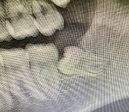 Avulsione di elementi inclusi inferiori con metodica tradizionale Fig. 1 OPT preoperatoria.