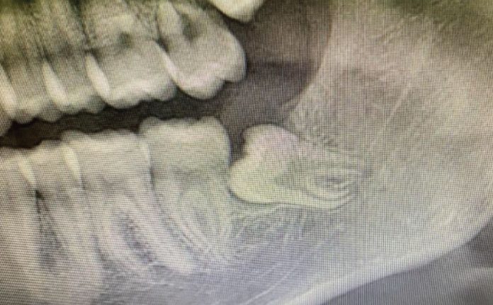 Fig. 1 OPT preoperatoria. Fig. 1 OPT preoperatoria.