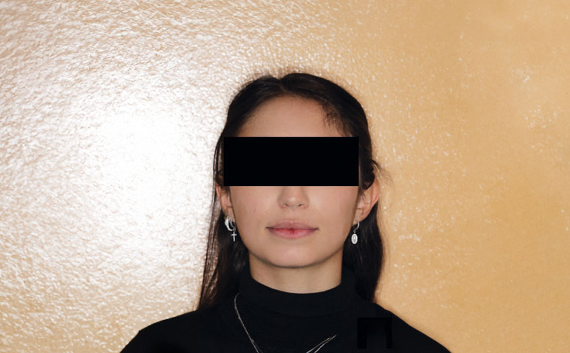 Fig. 1A Foto frontale a riposo.