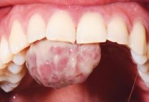 Fig. 1 Foto intra-orale che mostra la presenza di una lesione sessile a livello del palato.