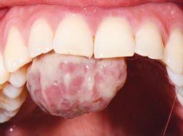 Fig. 1 Foto intra-orale che mostra la presenza di una lesione sessile a livello del palato.