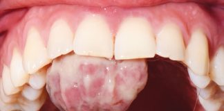 Fig. 1 Foto intra-orale che mostra la presenza di una lesione sessile a livello del palato.