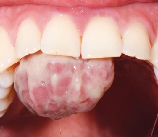 Fig. 1 Foto intra-orale che mostra la presenza di una lesione sessile a livello del palato.