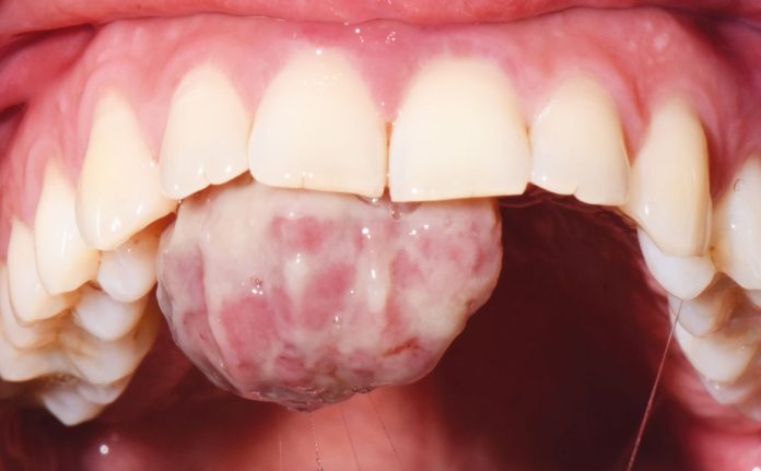 Fig. 1 Foto intra-orale che mostra la presenza di una lesione sessile a livello del palato.