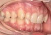 Fig. 1A Fotografia intraorale iniziale.