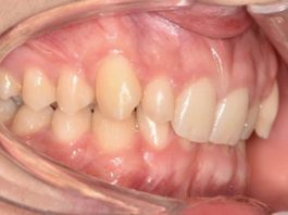 Fig. 1A Fotografia intraorale iniziale.