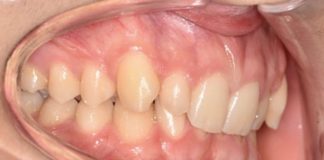 Fig. 1A Fotografia intraorale iniziale.