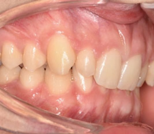 Fig. 1A Fotografia intraorale iniziale.