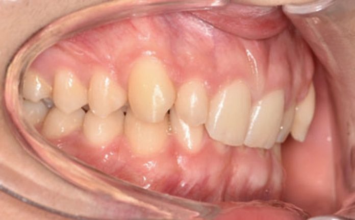 Fig. 1A Fotografia intraorale iniziale.