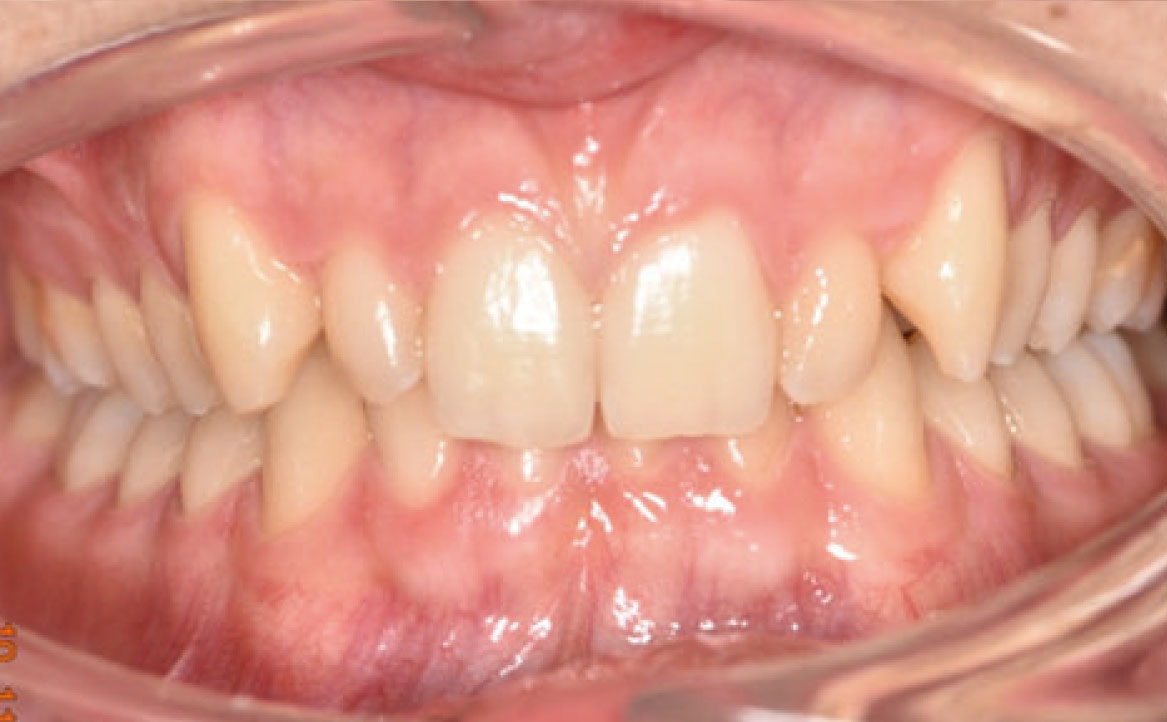 Fig. 1B Fotografia intraorale iniziale.