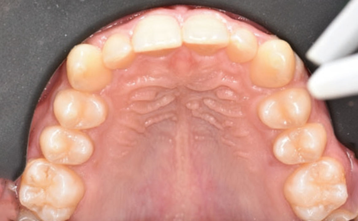 Fig. 1D Fotografia intraorale iniziale.