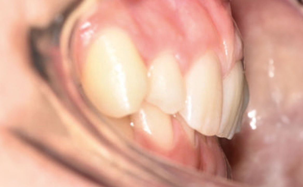 Fig. 1E Fotografia intraorale iniziale.