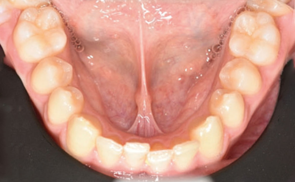 Fig. 1F Fotografia intraorale iniziale.