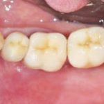 Fig. 2 Immagine iniziale del 4 sestante con visione occlusale.