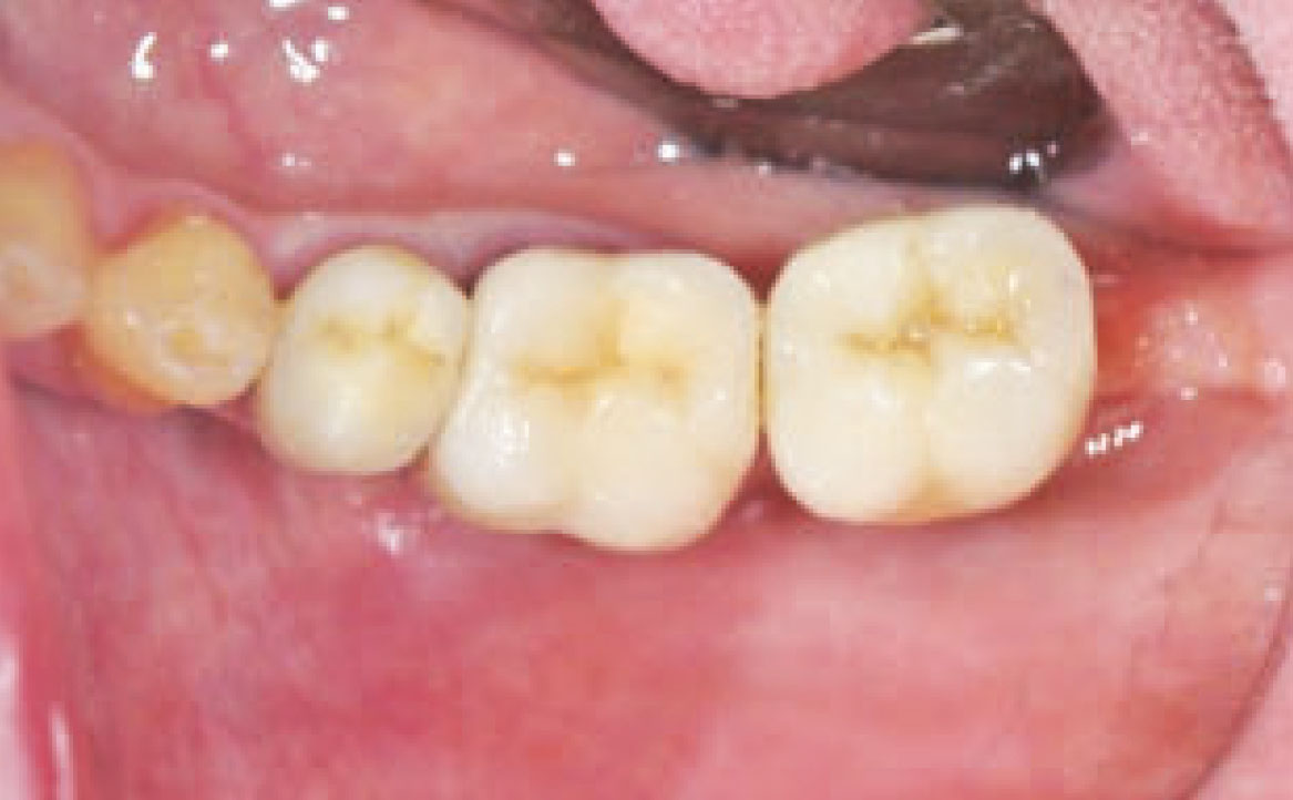 Fig. 2 Immagine iniziale del 4 sestante con visione occlusale.