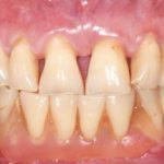 Fig. 2 Foto intraorale: presenza nella mandibola di una protesi incongrua ancorata a elementi dentari.