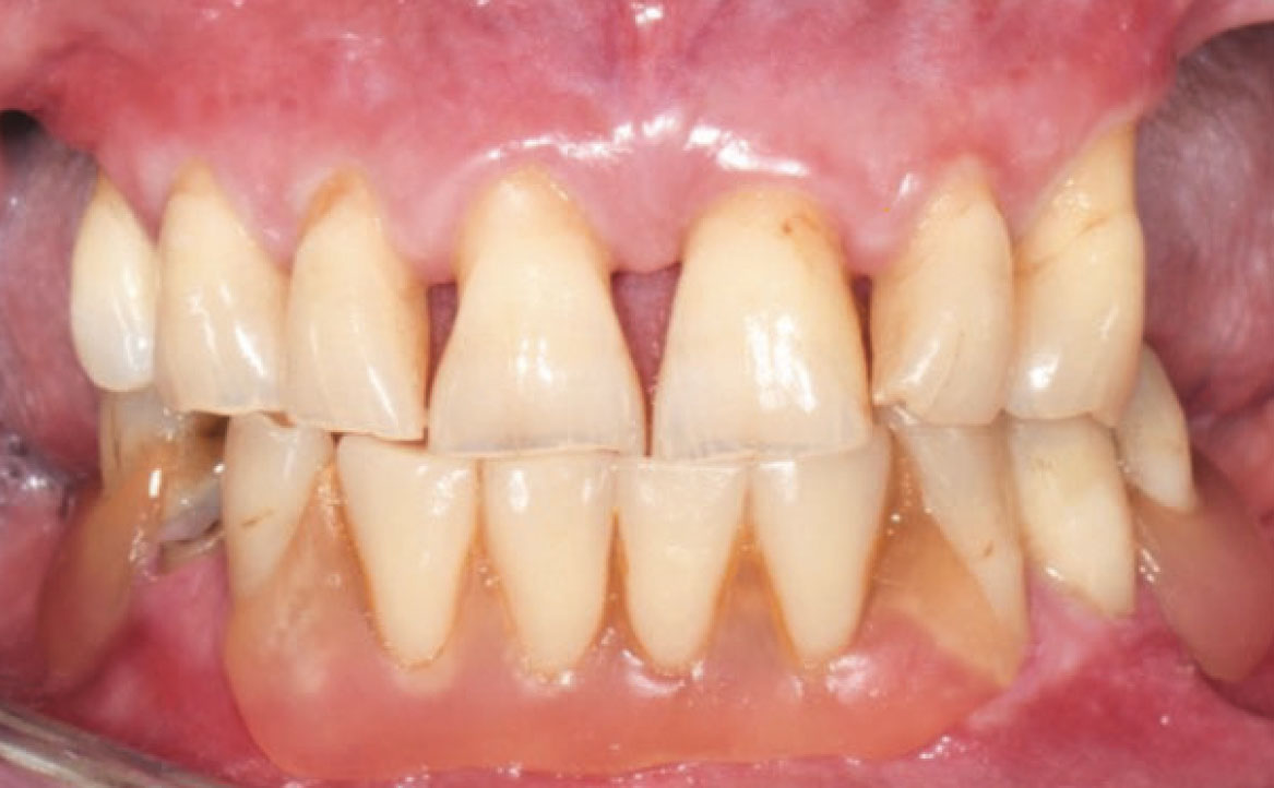 Fig. 2 Foto intraorale: presenza nella mandibola di una protesi incongrua ancorata a elementi dentari.