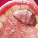 Fig. 2 Foto intra-orale che mostra la presenza di una lesione sessile a livello del palato.