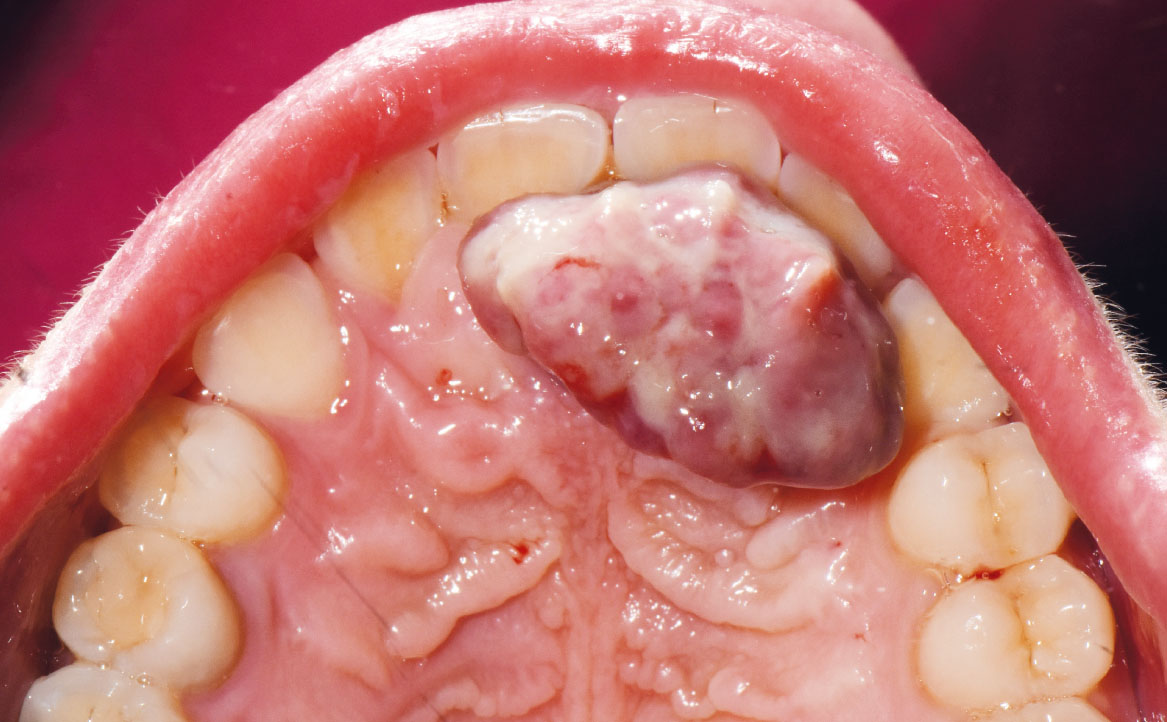 Fig. 2 Foto intra-orale che mostra la presenza di una lesione sessile a livello del palato.