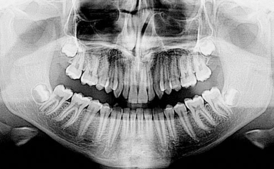 Fig. 2A OPT iniziale.