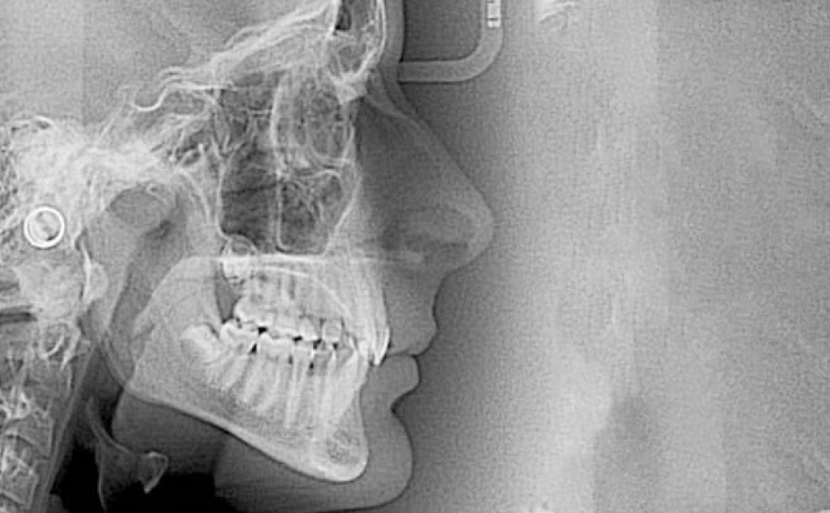 Fig. 2B Teleradiografia latero-laterale del cranio.