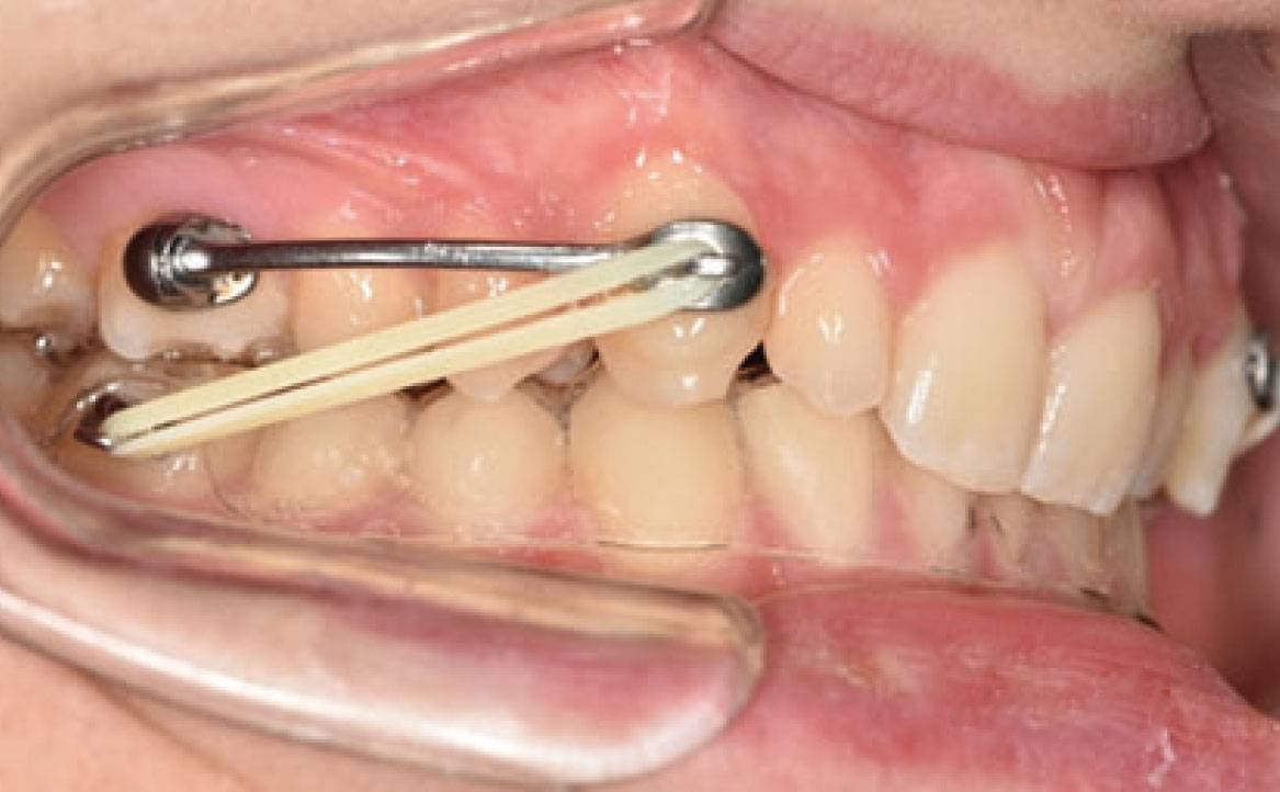 Fig. 2C Carriere Motion e elastici di Classe II.