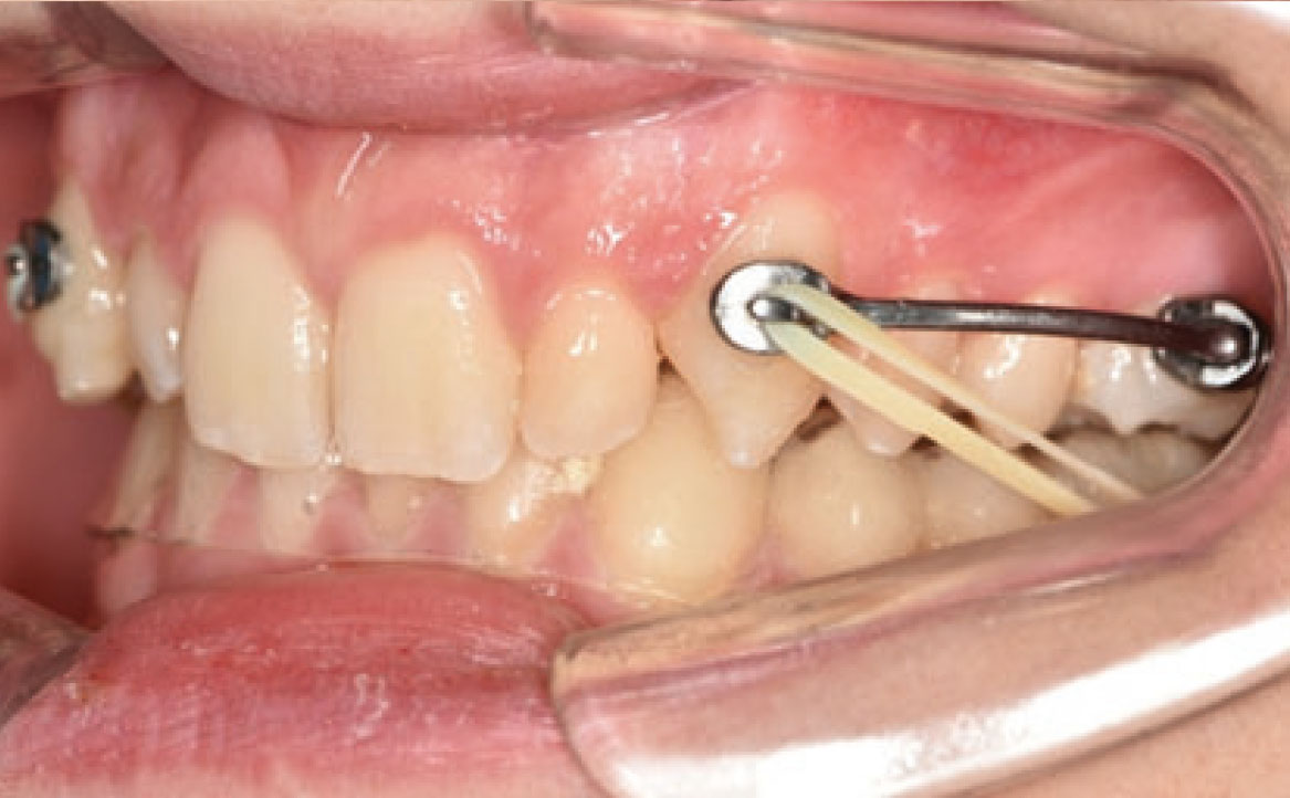 Fig. 2E Carriere Motion e elastici di Classe II.