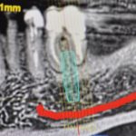 Fig. 3 ICBCT con posizionamento di un impianto virtuale e segnalazione del nervo alveolare inferiore.
